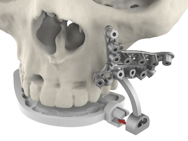 3D Systems Announces VSP Hybrid Guides — Delivering Breakthrough Patient-specific, Occlusal-based Solution for Maxillofacial Surgeries
